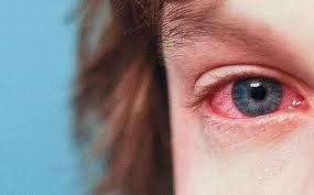 eyes affected by allergy