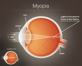 Myopia illustration