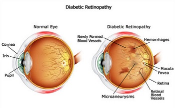 diabetic retinopathy figure