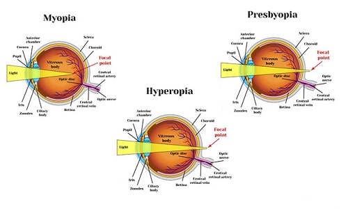 Myopia, Hyperopia And Presbyopia illustration
